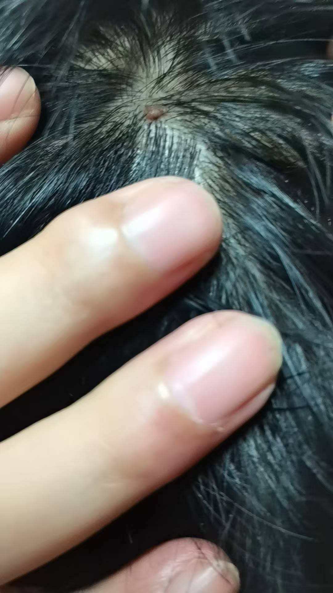 头上出了个猴子，医院激光打掉要200左右，毛呢赶紧发毛我要去医院

81 / 作者:随缘1022 / 