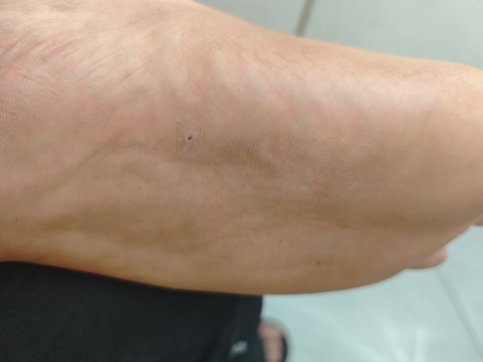 前段时间被铁钉扎了，现在变成这样了。不知道有木有事情。破伤风没打

29 / 作者:时间的新欢 / 