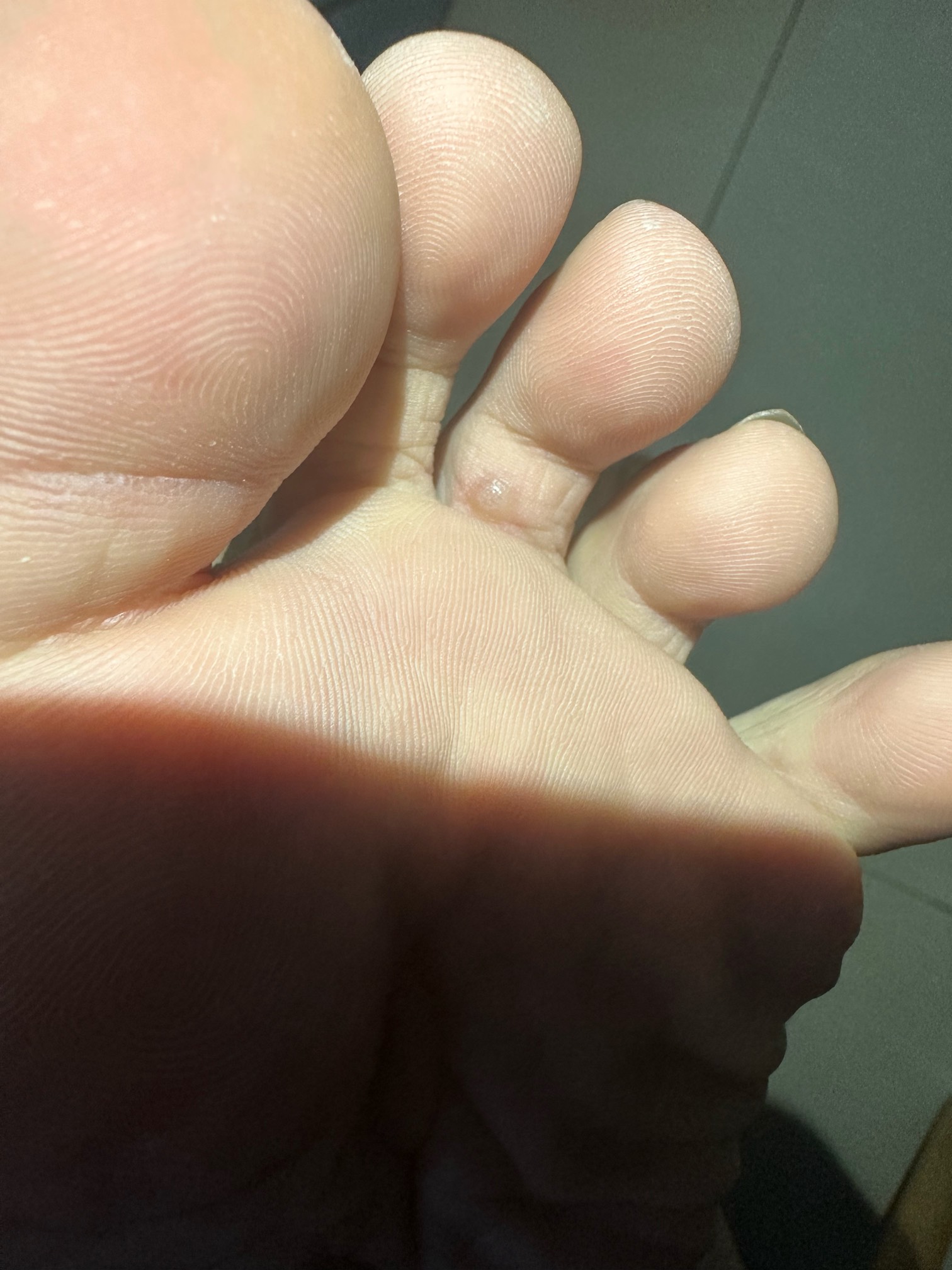 老哥们我脚趾长了个水泡这是啥，有点痒

61 / 作者:美依礼芽 / 