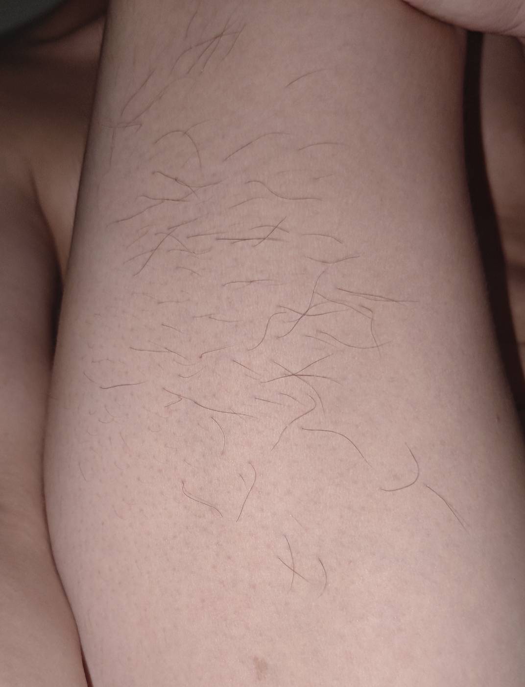 为什么大腿后面也长好多毛，有老哥这样的吗

24 / 作者:撸毛小王子 / 