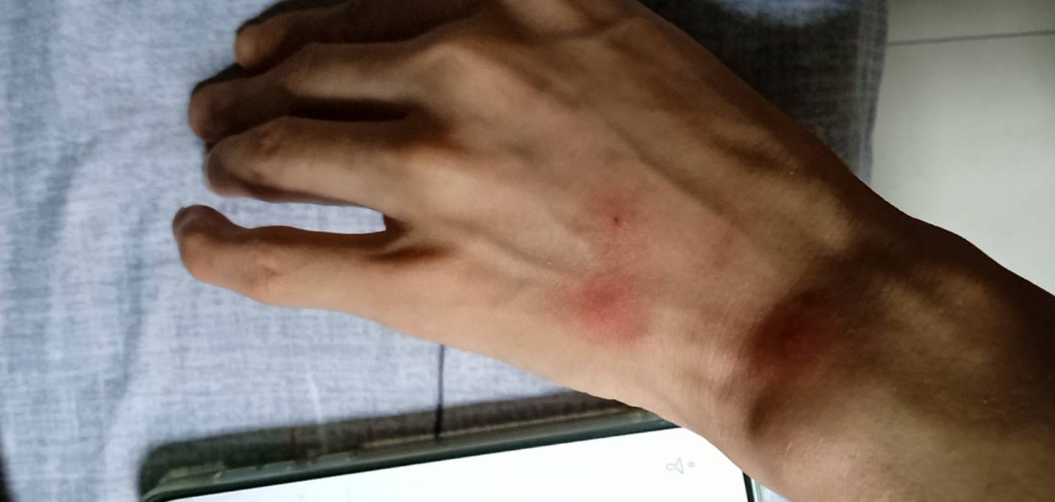 广东这蚊虫真的毒老哥们怎么解决的 蚊帐都不管用
1 / 作者:家怡 / 