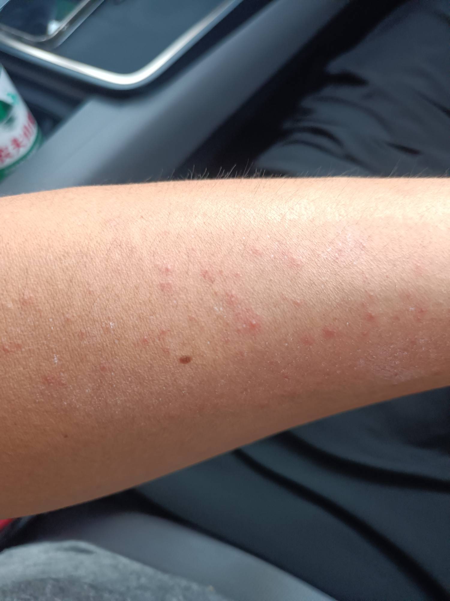 昨天的日结工资到了，挣点钱不容易啊，太热痱子都冒出来了，今天抹了药好多了。



83 / 作者:生蚝熟了 / 