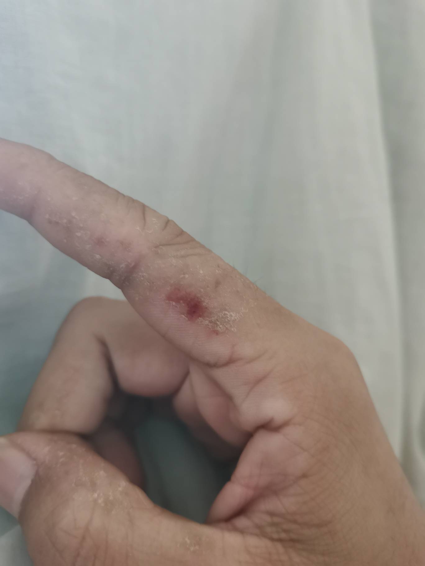 老哥们有手指汗疱疹的吗 在广东三个多月了一直不好 洗衣服带手T就是洗手都烂是不是没29 / 作者:梦想当村长 / 