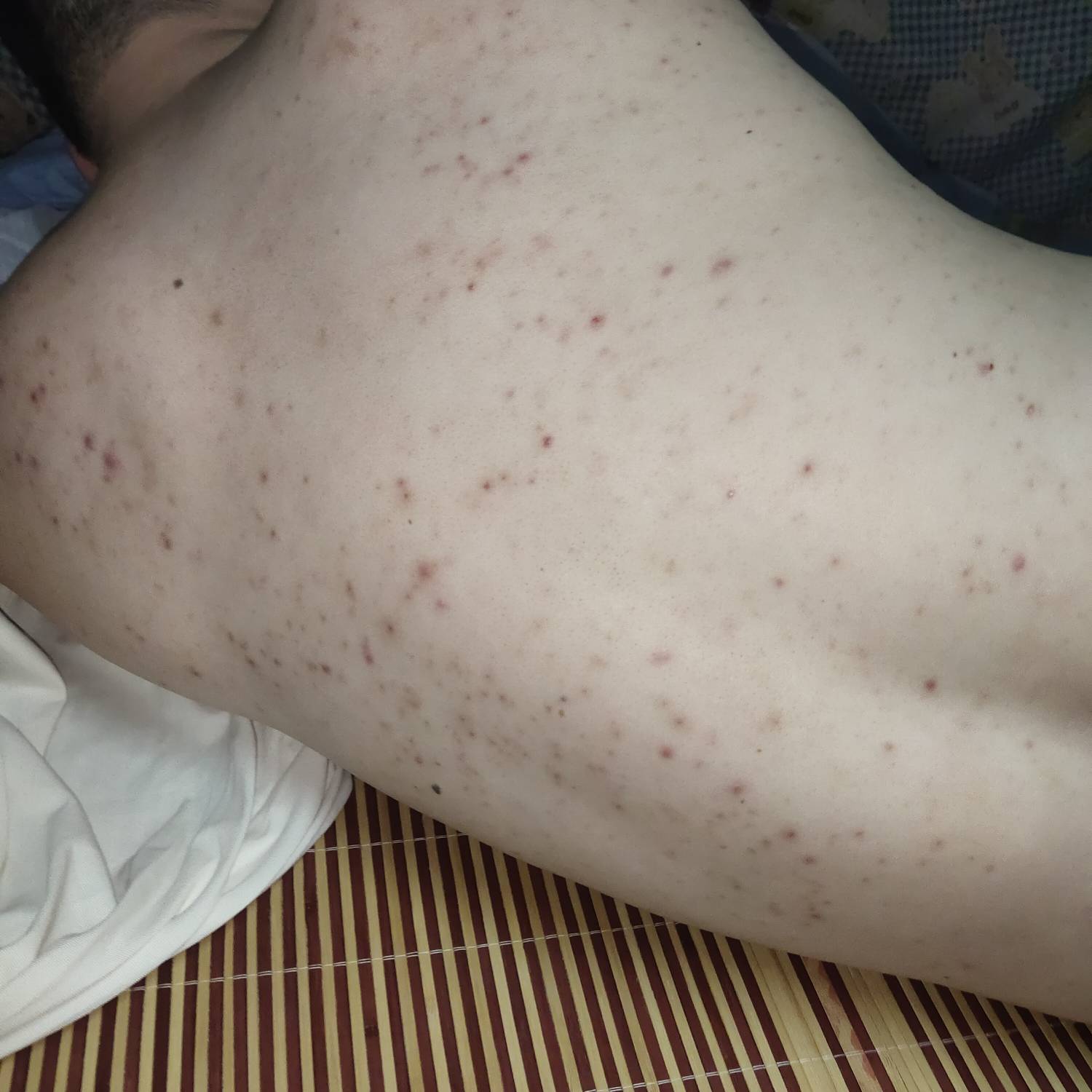 老哥们有得过这种的吗，应该怎么治

92 / 作者:ksksj23 / 