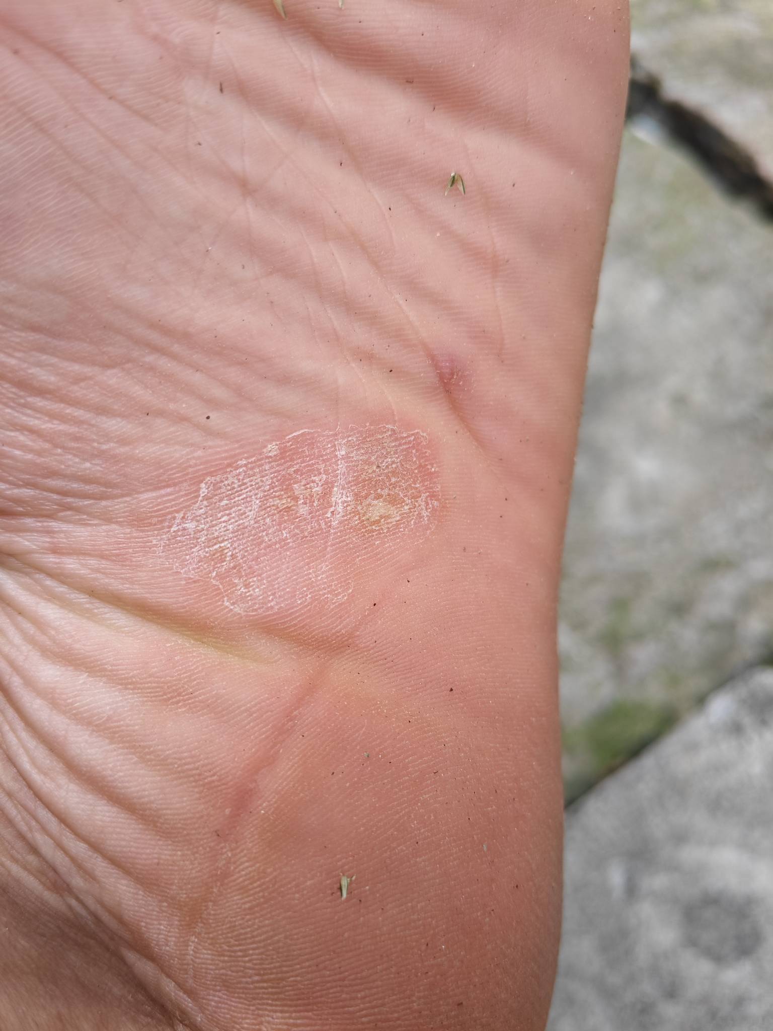 999皮肤发炎平没用，老哥们看看什么情况

60 / 作者:雾都平稳的仙茅 / 