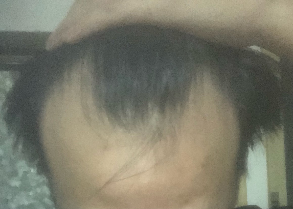 有m秃老哥吗，我31发际后移成这样了，又没钱植发-哎！

84 / 作者:区委叔记 / 