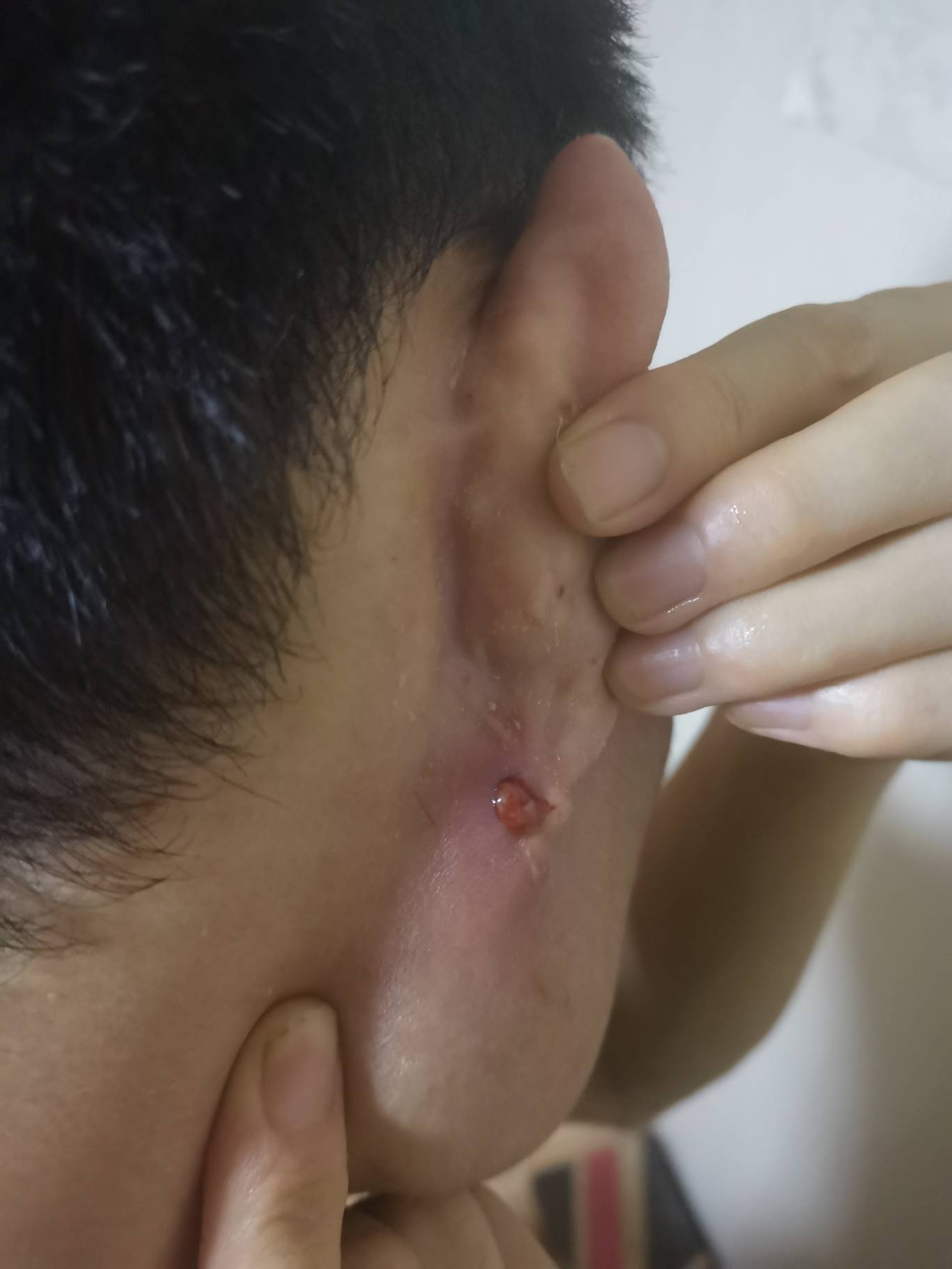 干活出汗就这样了 想挤但是不够大 摸着很解压这是毛囊炎吗小时候叫酒刺

54 / 作者:5900 / 