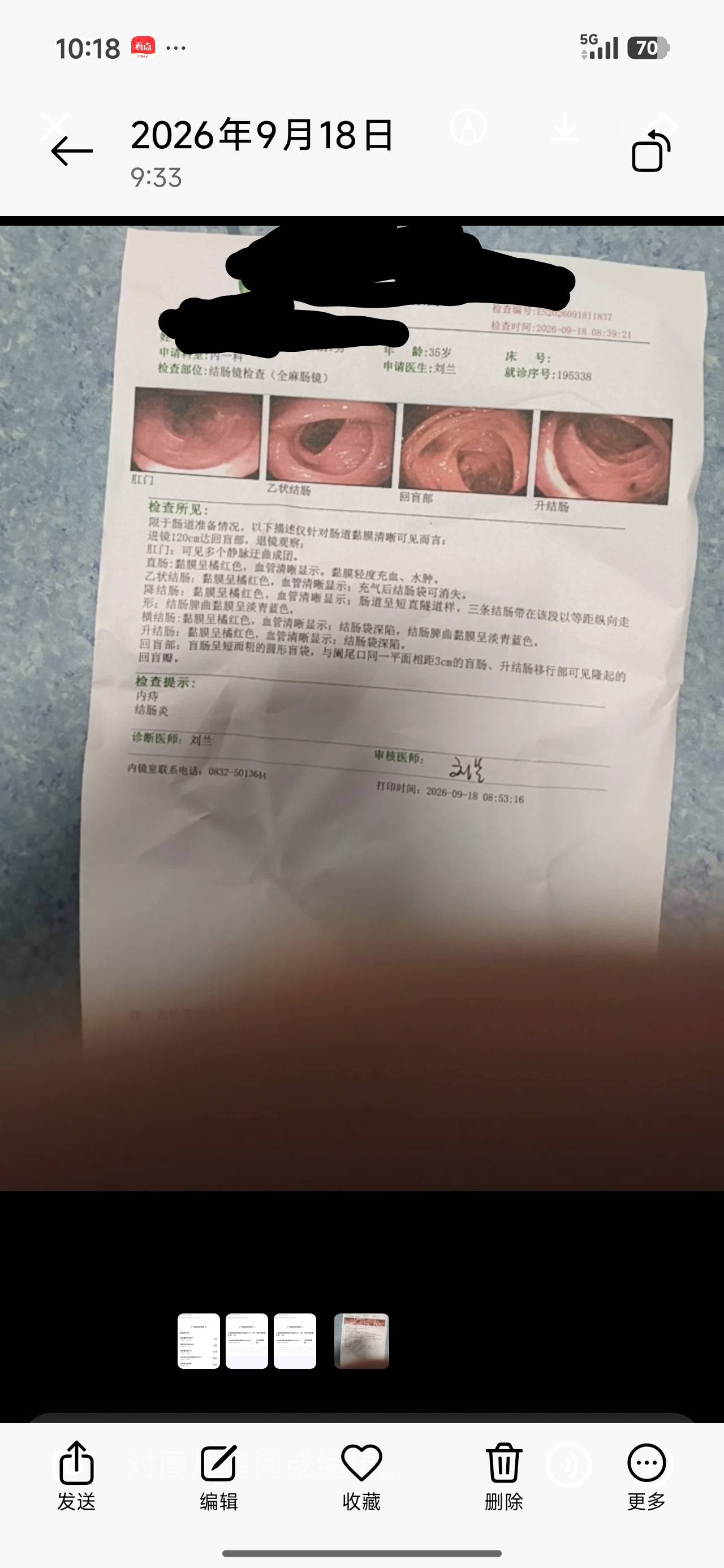 老哥们，焦虑解除

我本来以为我长期大便不成型，一天腹泻2-3次有问题，做了肠镜，判15 / 作者:晶莹剔透111 / 