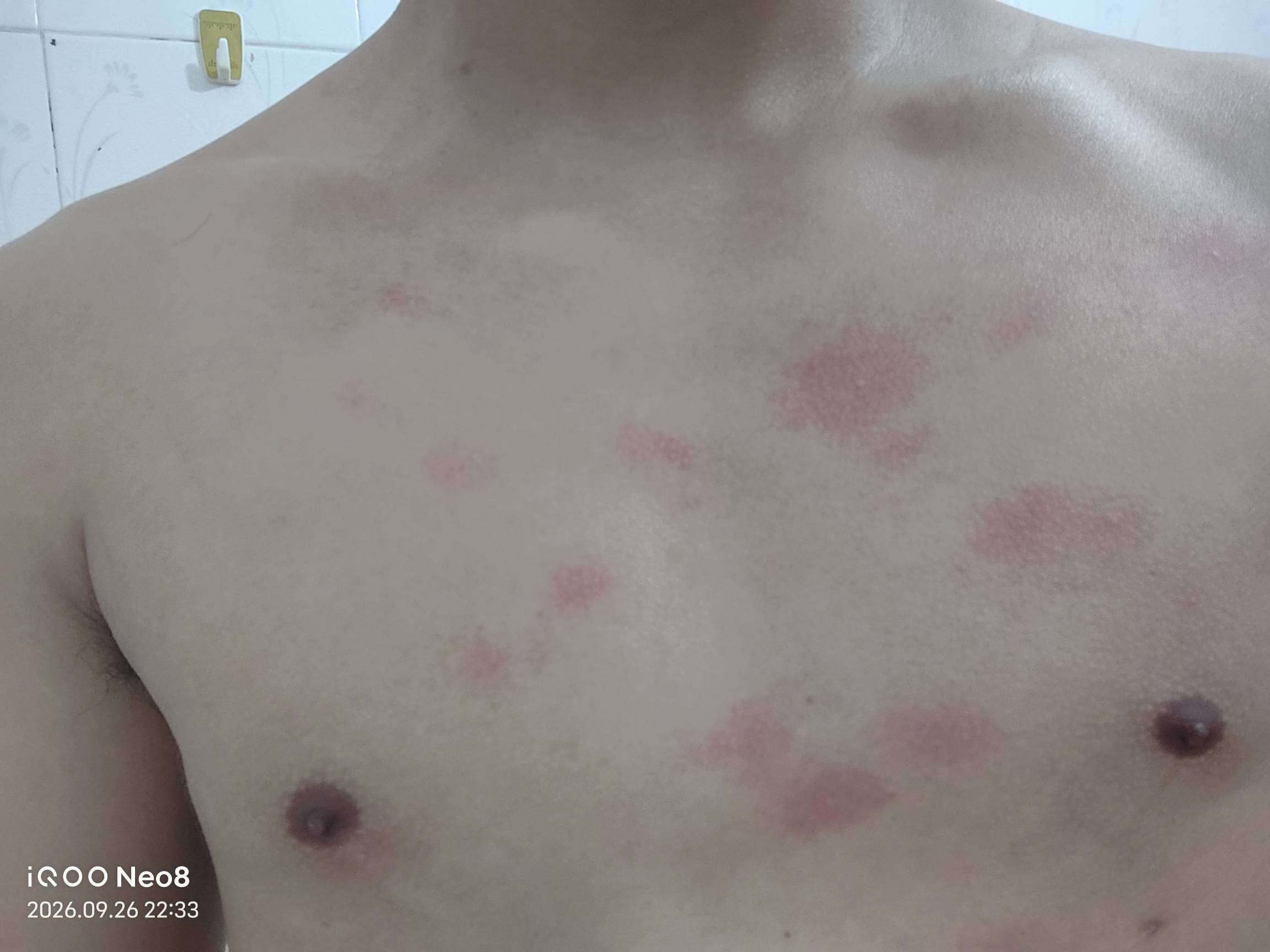 东莞这鬼天气。每天这么热，洗衣服的时候胸口全是这个，吹几小时空调就没了，我真怕热73 / 作者:晴空免疫性 / 