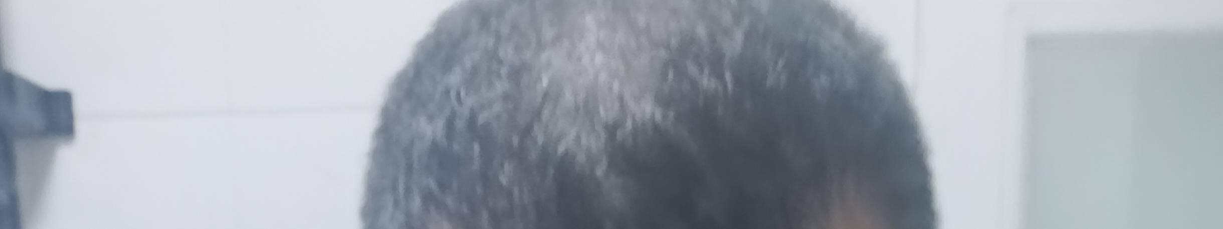 老哥们，遗传秃顶怎么治啊。现在都能看到头皮了。

19 / 作者:mmmmkbh / 