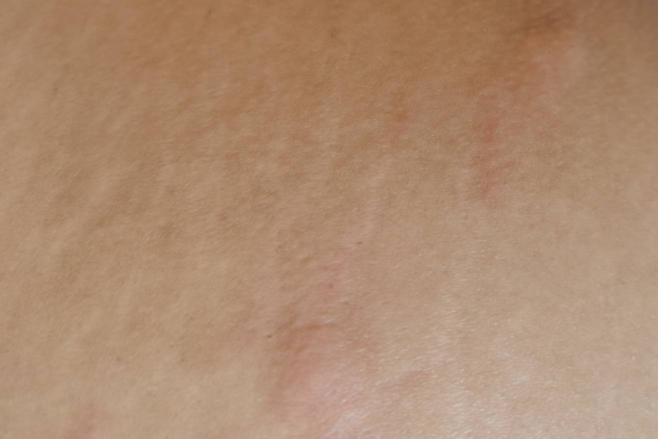 老哥们挂壁机像素不行 这两个包是偏红色的 是不是臭虫啊 实际比拍的大 像是大型蚊子包18 / 作者:任万事自然流动 / 